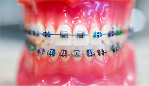 จัดฟันโลหะแบบติดแน่น Metal Brace จัดฟันโลหะแบบติดแน่น Metal Brace