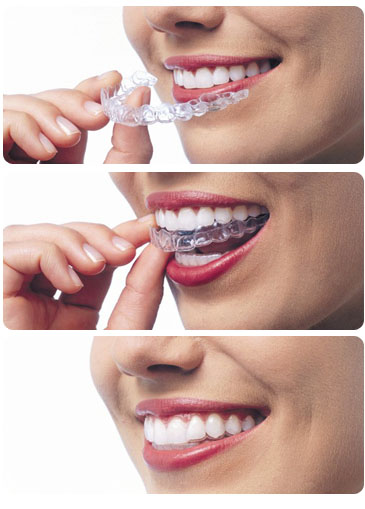 จัดฟันแบบใส INVISALIGN จัดฟันแบบใส INVISALIGN