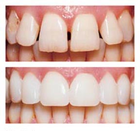 เคลือบผิวฟัน Veneer เคลือบผิวฟัน Veneer