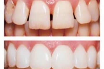 เคลือบผิวฟัน Veneer
