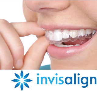 จัดฟัน Invisalign คือ อะไร จัดฟัน Invisalign คือ อะไร