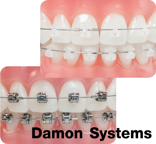 การจัดฟันด้วยเครื่องมือติดแน่นด้านนอกแบบดามอน (Damon™ System)